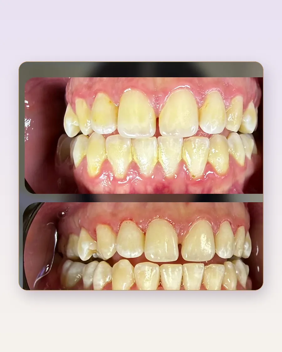 Resultado real de micro diseño de sonrisa
