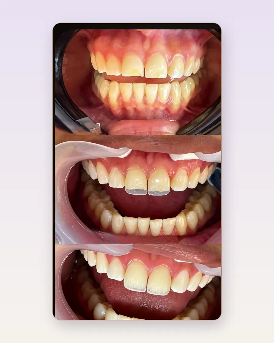 Secuencia real de limpieza y pulido dental