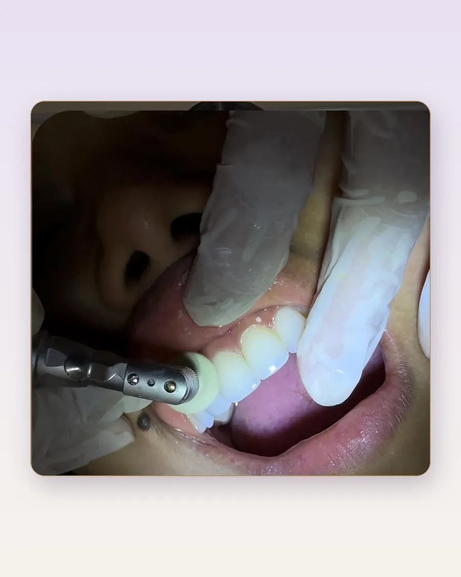 Procedimiento real con aislamiento dental