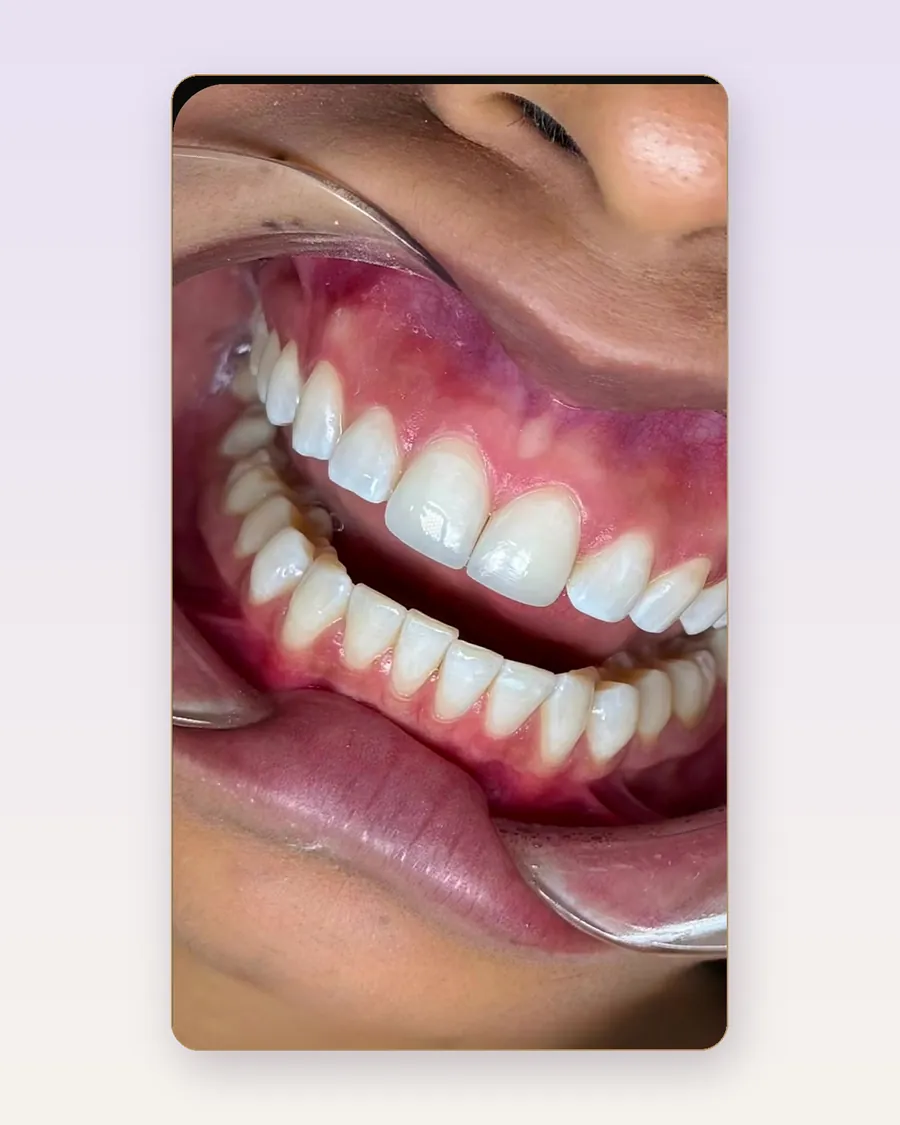 Sonrisa real de paciente tras su diseño de sonrisa